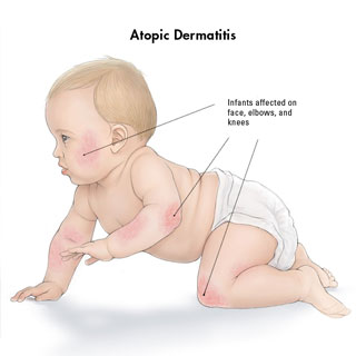 atopic-dermatitis-baby