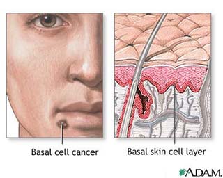 basal-cell-carcinoma-diagram