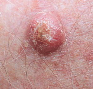 skin-cancer-melanoma