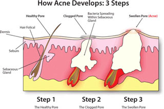 acne-diagram