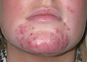 acne-vulgaris-skin