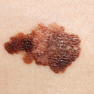 melanoma-spot