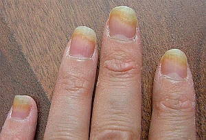 nail-fungus-infection