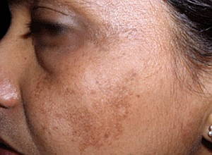 melasma-facial-pigmentation-skin