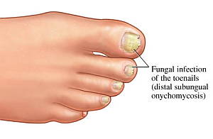 onychomycosis-nail