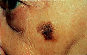 Lentigo_melanoma