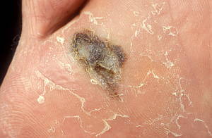 acral-lentiginous-melanoma