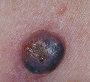 nodular-melanoma