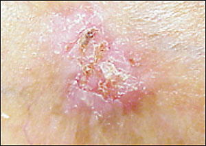 sclerosing-BCC