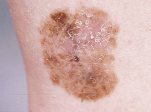 superficial-spreading-melanoma
