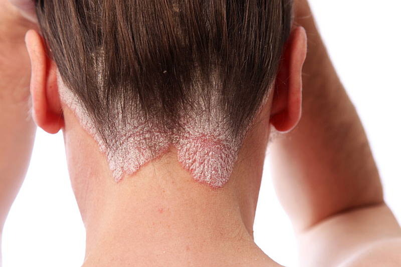 Hair fungus Treatment Causes Symptoms  Preventions